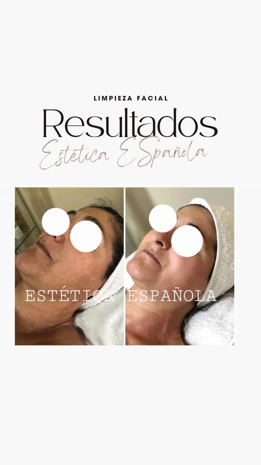 Limpieza Facial — Estética Española