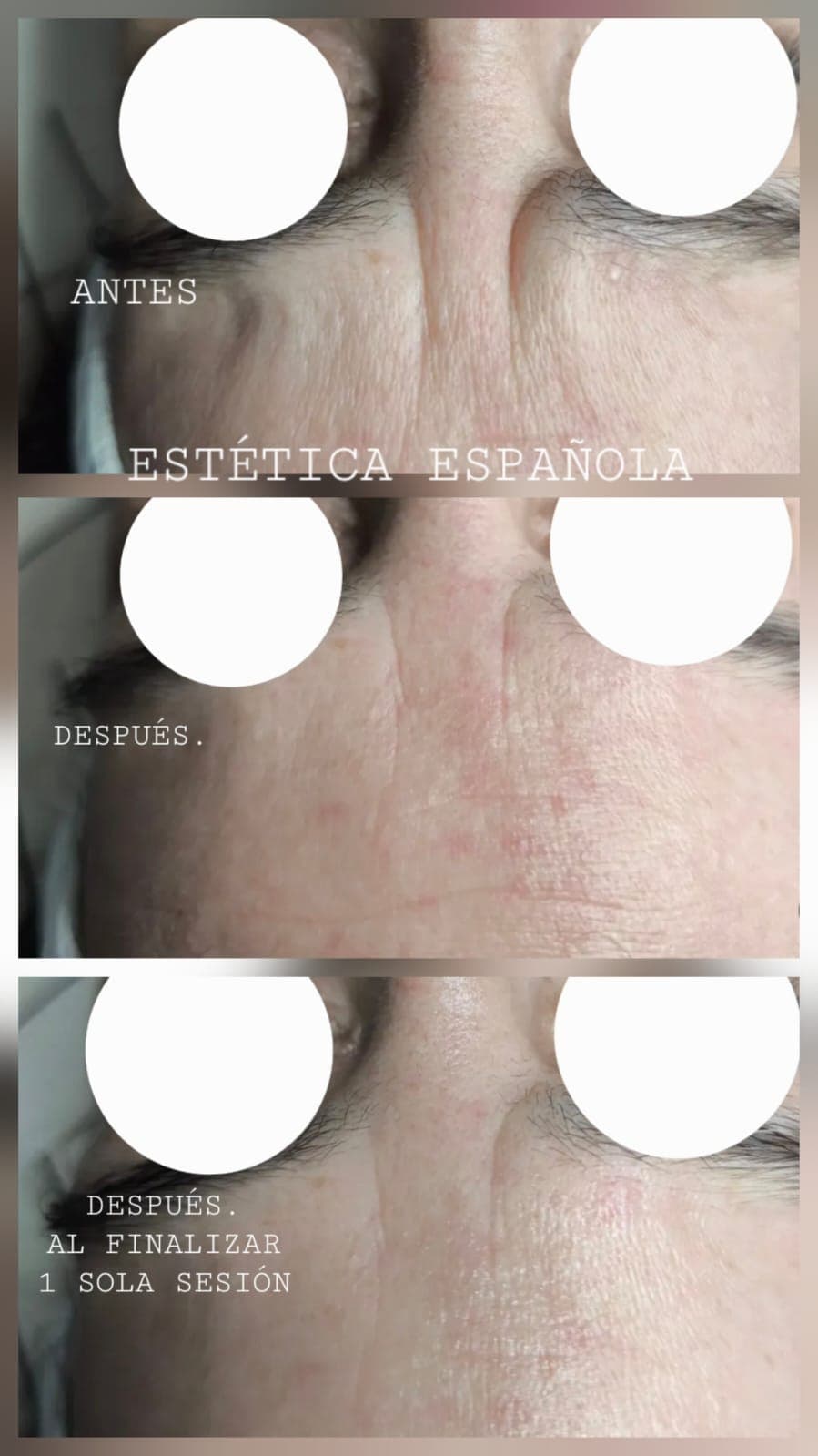 Limpieza Facial — Estética Española